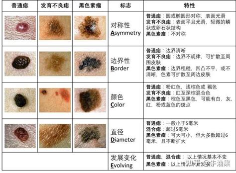 痣是凸的|痣是什麼？會變成黑色素瘤？7種一定要除的痣